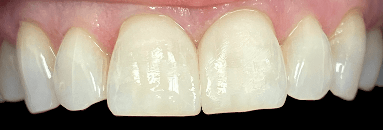 Bonded-Fillings-Cosmetic-Upgrade-After-Image