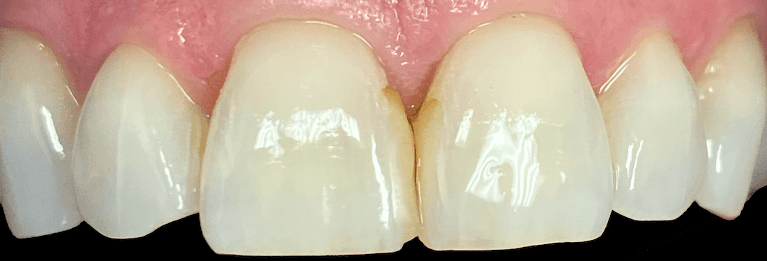 Bonded-Fillings-Cosmetic-Upgrade-Before-Image